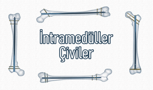 İntramedüller Çiviler