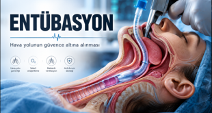 Entübasyon